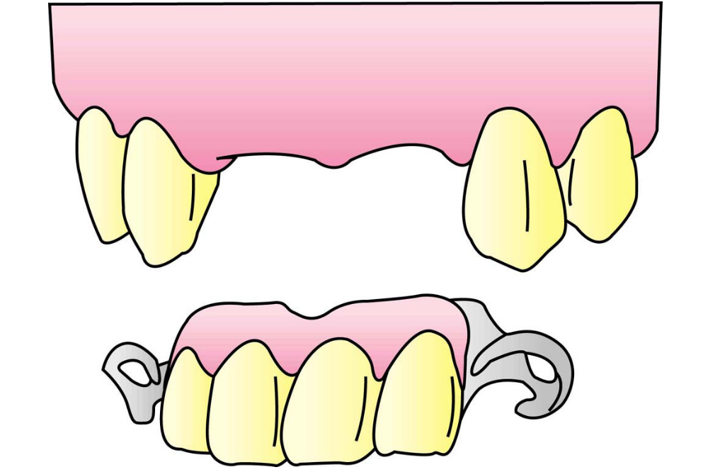 前歯の部分入れ歯