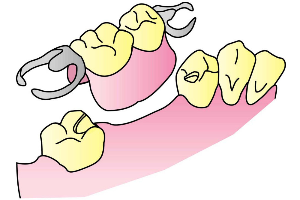 中間欠損の部分入れ歯