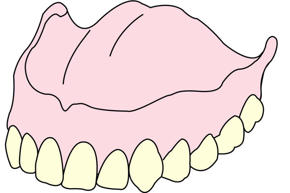 総入れ歯（保険）上顎