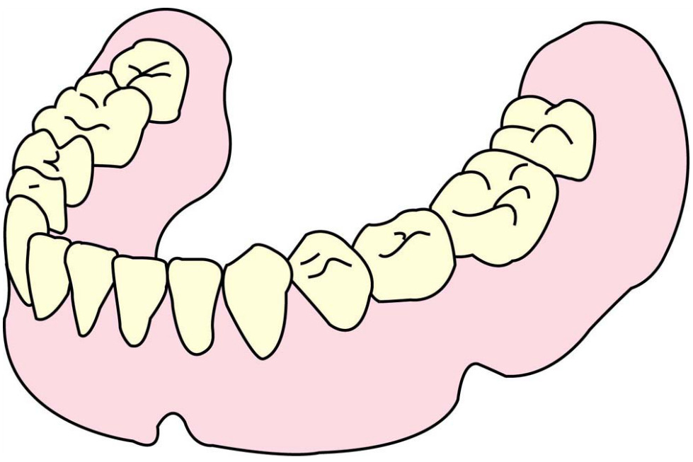 総入れ歯（保険）下顎