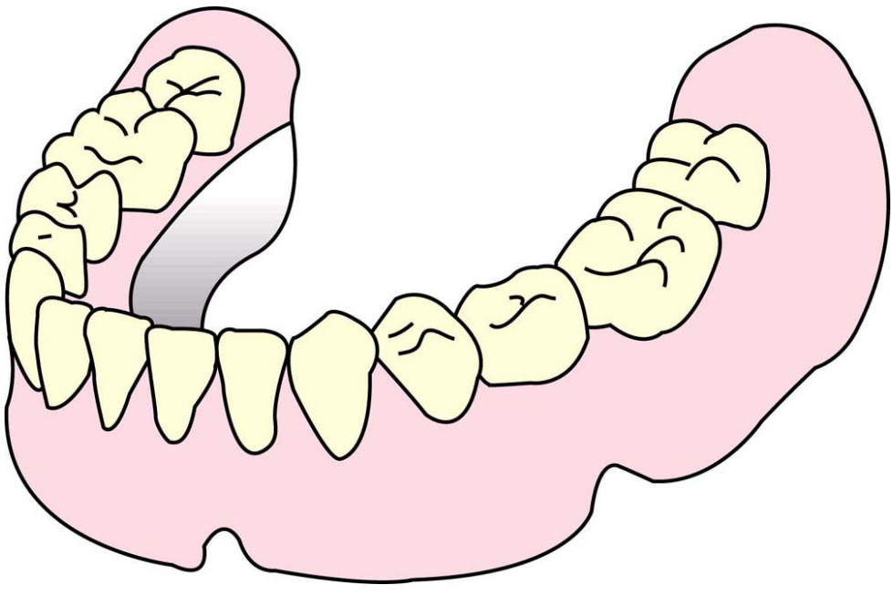総入れ歯（自費）下顎