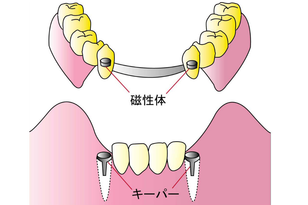 磁性アタッチメント義歯（自費）