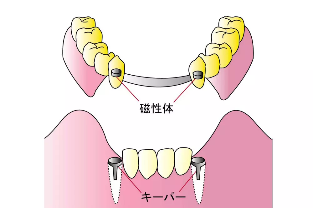 磁性アタッチメント義歯