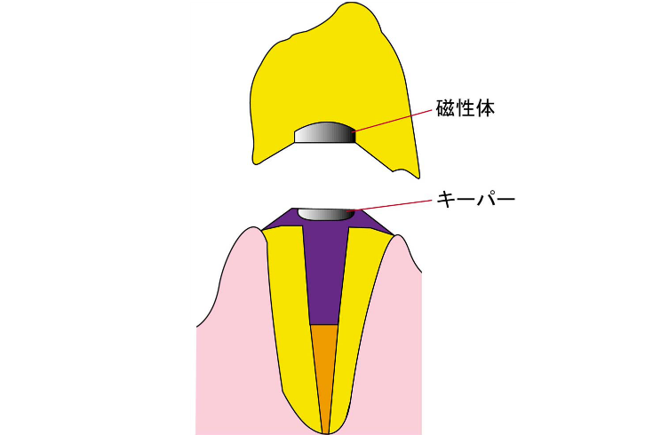 磁性アタッチメント義歯（拡大図）