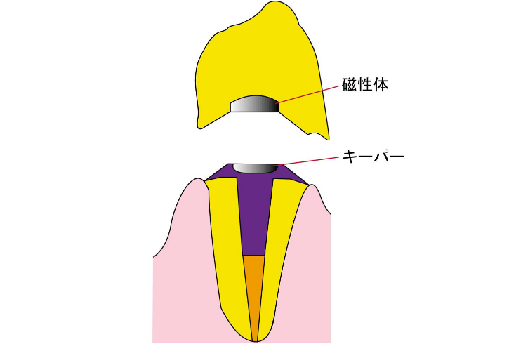 磁性アタッチメント義歯
（自費）断面図