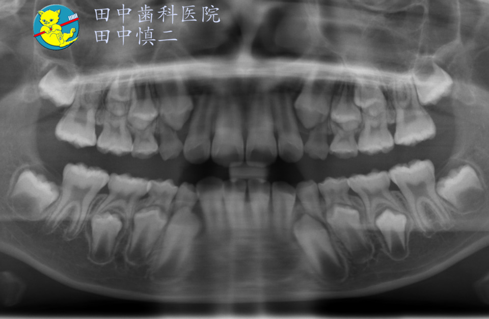 十二歳臼歯