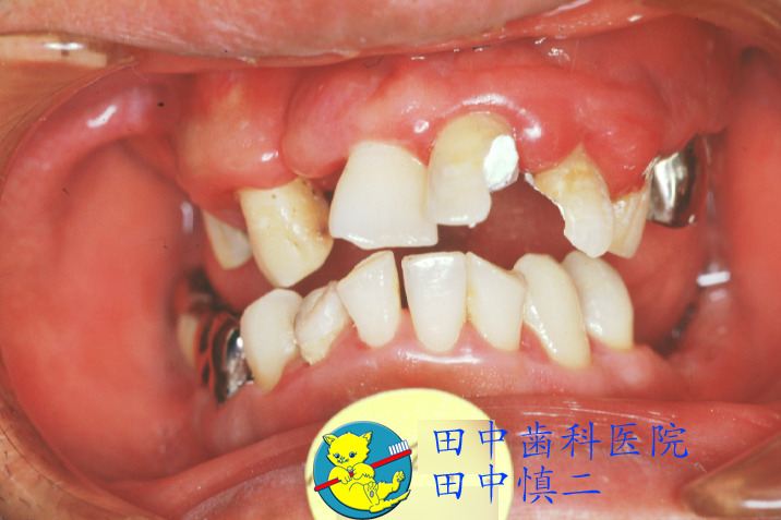 歯周病の口