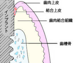 インプラント