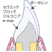 オールセラミック（自費）