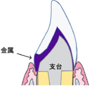 メタルボンド（自費）