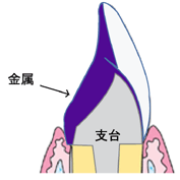 硬質レジン （保険）