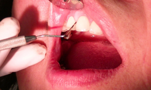 歯周病の診査