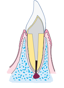 根管が腐った
