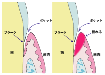 歯周病
